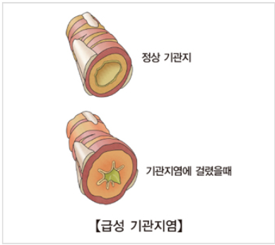 ▲ 정상기관지와 기관지염에 걸렸을 때 기관지 출처 : 서울아산병원