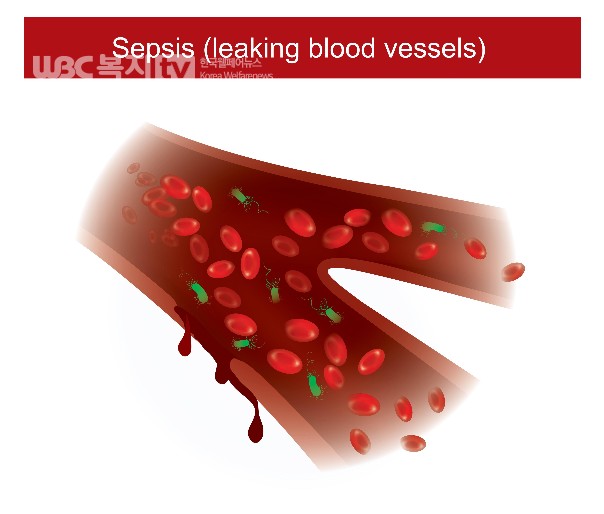 패혈증(sepsis)
