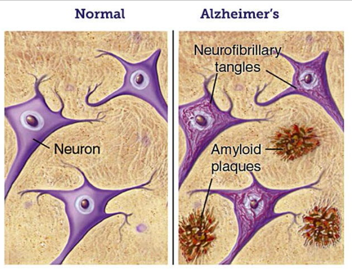 ▲ 정상인 뇌와 알츠하이머병을 앓고 있는 뇌